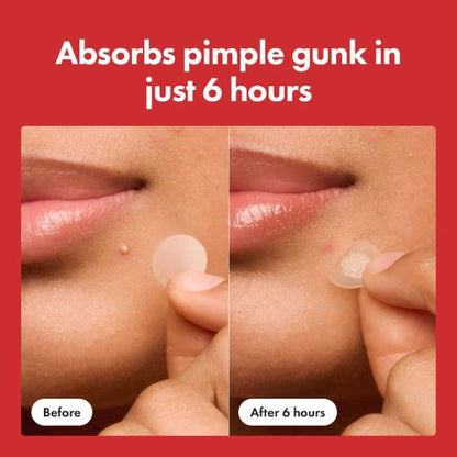 🌸50% 🌸off Hydrocolloid Acne Pimple Patch
